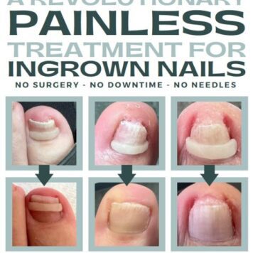 Bracenfix Nail NON-Invasive Igrown Nail Treatment